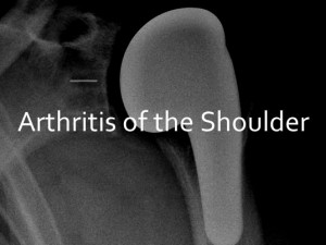 shoulder arthritis