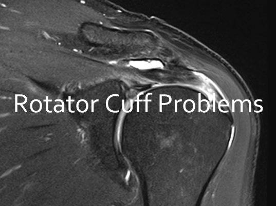 Rotator Cuff Problems - Canberra OrthopaedicsCanberra Orthopaedics