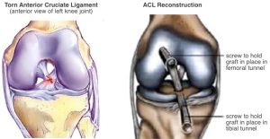acl reconstruction
